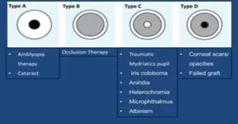 Aqua Comfort Prosthetic Lens